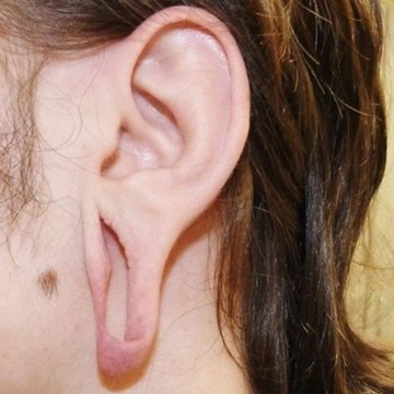 Возможные последствия туннелей ушей