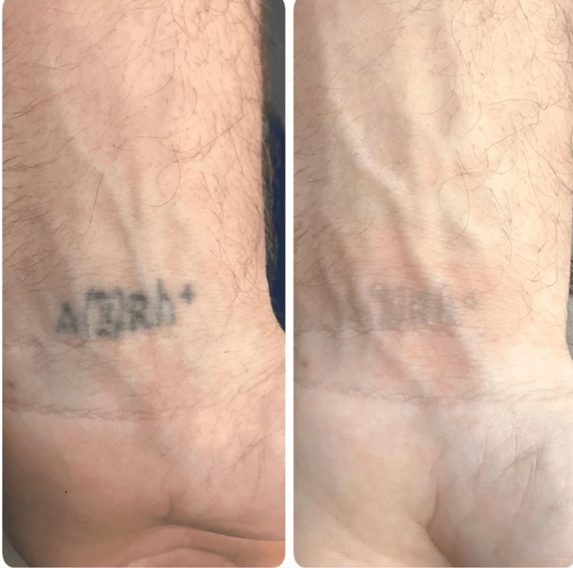 Сведение Татуировки лазером до и после